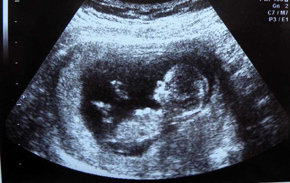 28 неделя беременности фото и развитие малыша — евромедклиник