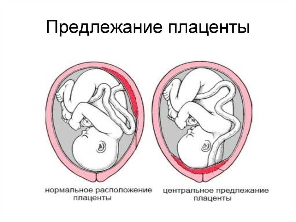 «лежачая» беременность – причины и последствия