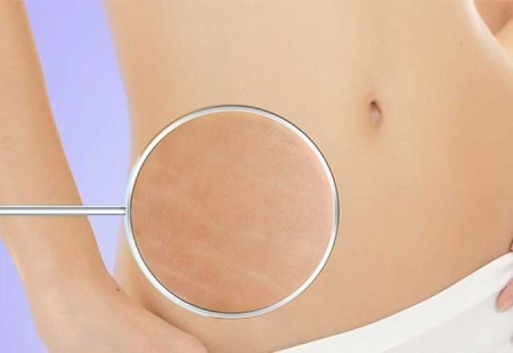Как убрать лишнюю кожу после похудения или родов - способы без операции и хирургические методы
