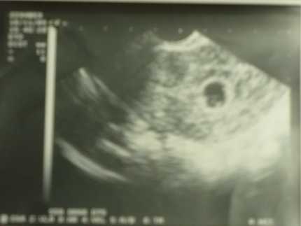 Беременность 5-6 недель. первые признаки, развитие малыша. узи. размеры плодного яйца