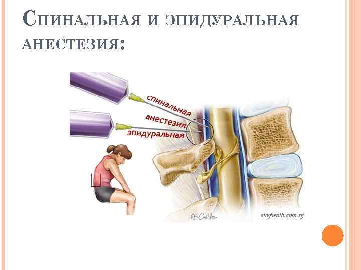 👶ответ эксперта: эпидуральная анестезия при кесаревом сечении 👪