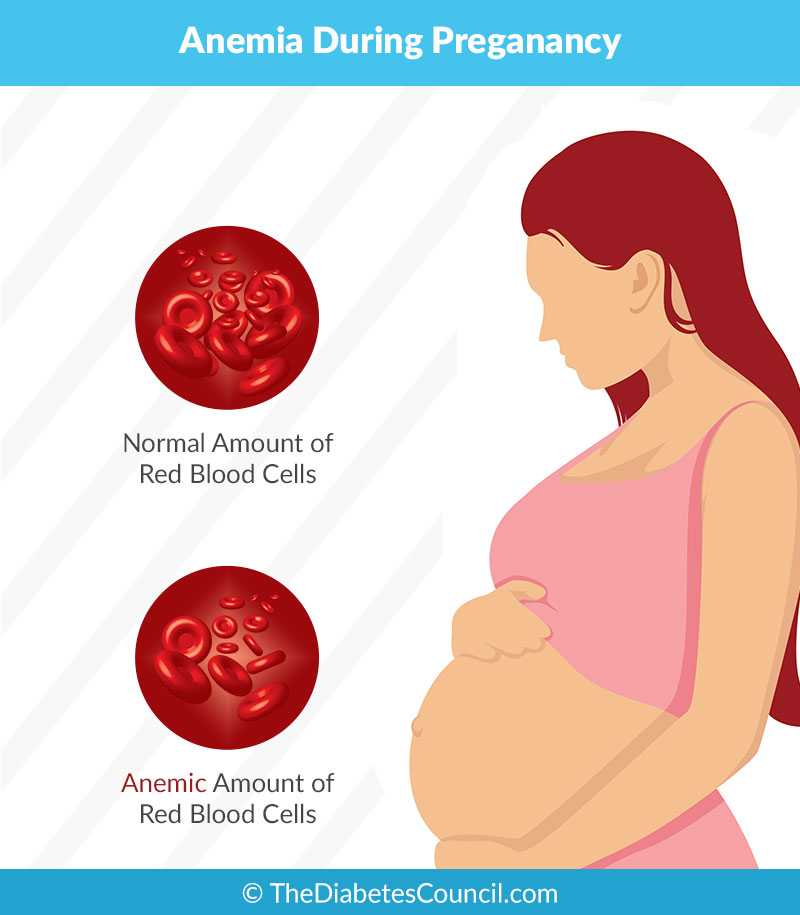 Анемия во время беременности. группы риска, профилактика и лечение.