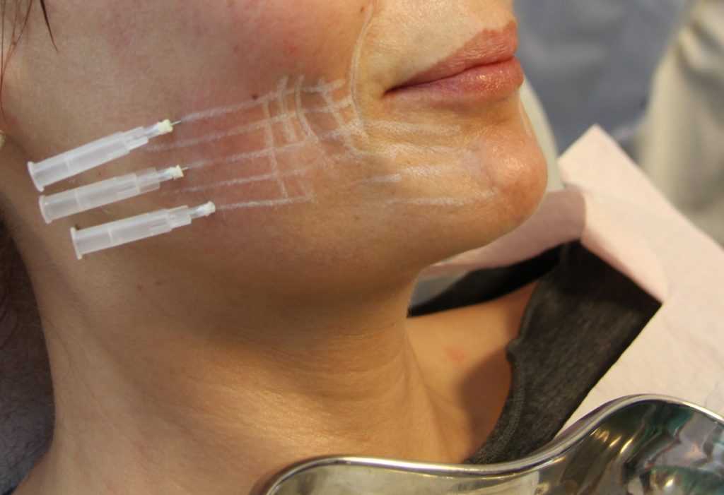 Введение филлеров (наполнителей) - эффективный метод коррекции скул - клиника косметологии