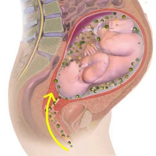 Хламидии при беременности