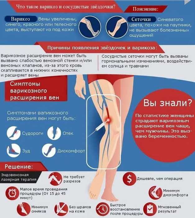 Профилактика варикоза ног (нижних конечностей)