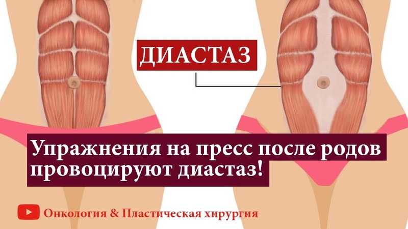 Лечение диастаза в клиническом центре сеченовского университета