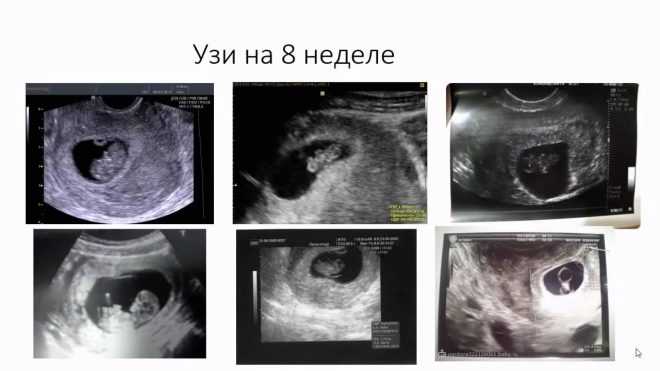 20 неделя беременности шевеления и фото  плода — евромедклиник