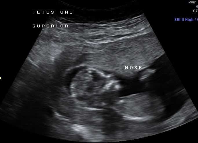 12 недель беременности. фото живота, плода, узи, что происходит, можно ли узнать пол ребёнка